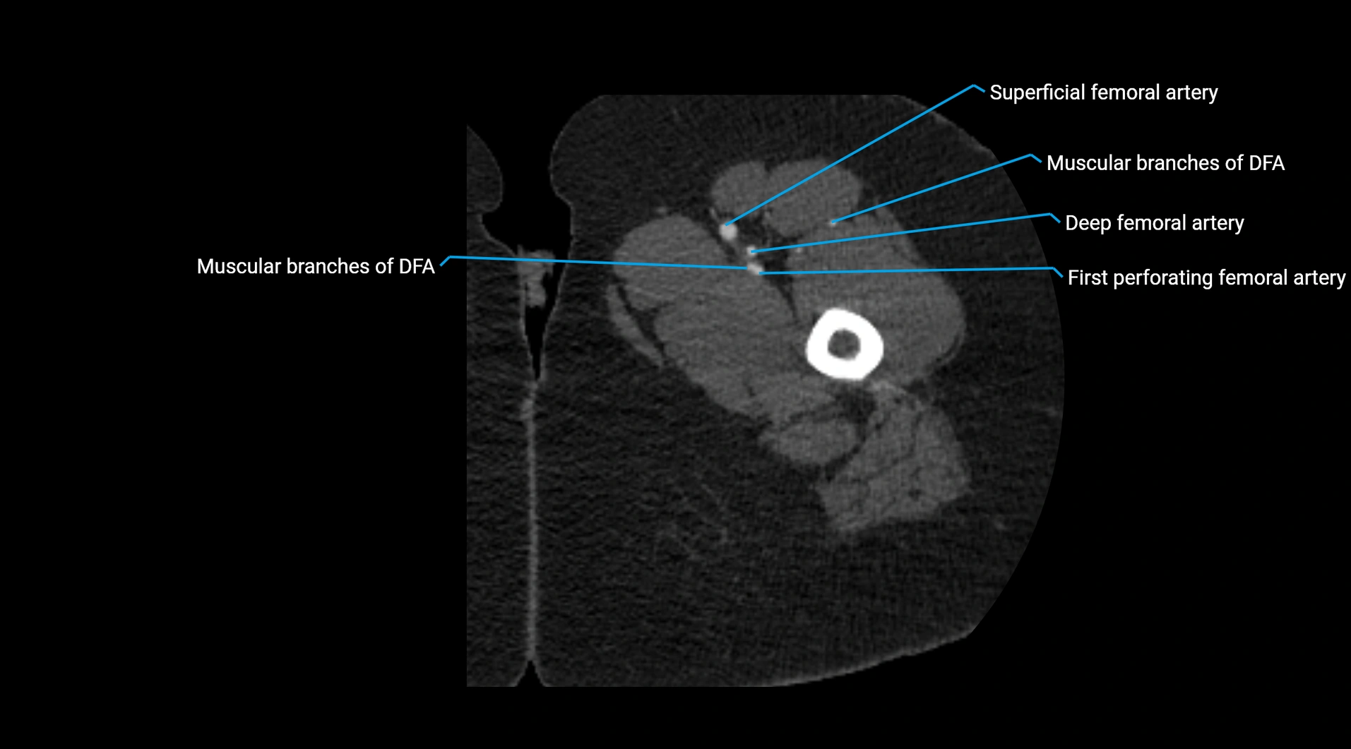 CTA lower limb cross sectional anatomy labelled image _87.webp